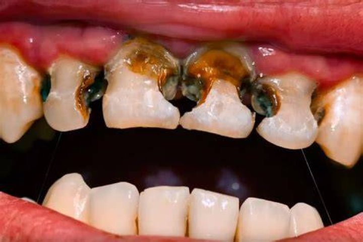 Bad Teeth Decayed teeth affected Dental Implants