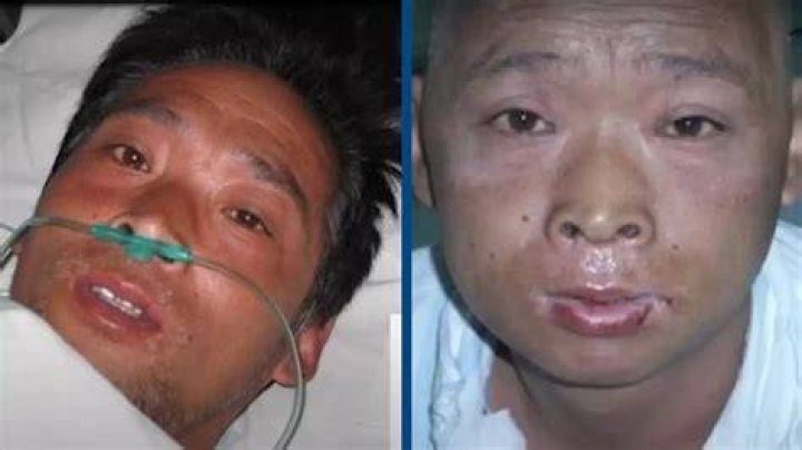 Hisashi Ouchi Radiation Exposure Images and Photos finder