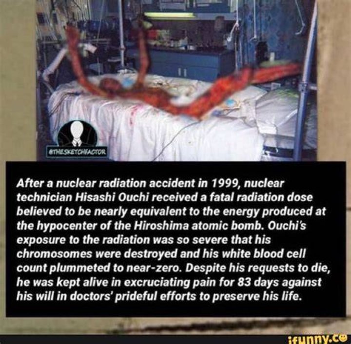 Hisashi Ouchi's Body After Radiation A Gripping Tale Of Survival And