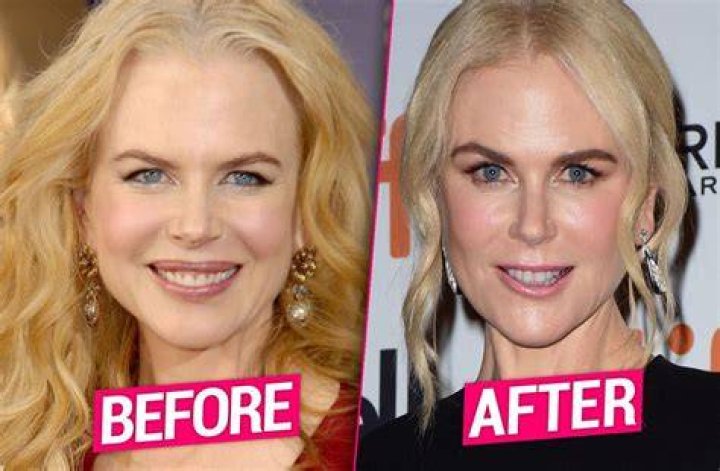 Nicole Kidman Plastic Surgery Photos [Before & After] ⋆ Surgery4