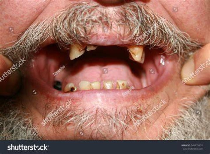 Rotten bad teeth. Beard and mustache. Caries. Periodontal disease