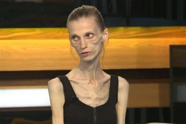 Woman battling anorexia pleads for help online